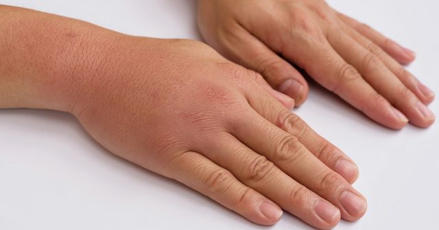 Пораженные участки кожи могут опухать и краснеть Пораженные участки кожи могут опухать и краснеть