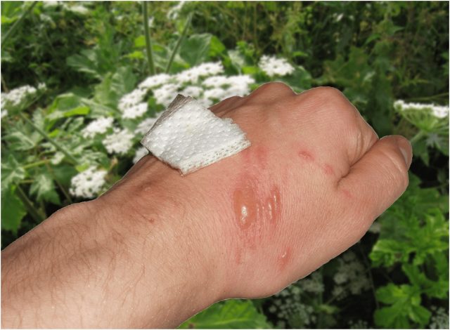 Ожоги от борщевика — одна из самых серьезных угроз. В соке растения содержатся фуранокумарины — вещества, которые в несколько раз усиливают чувствительность кожи к солнечному свету.