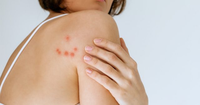 Первый признак – это, конечно, укусы клопов на теле человека.